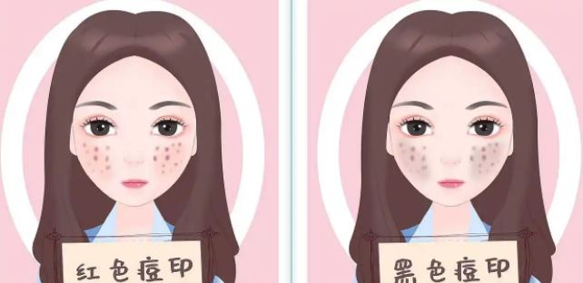 臉上紅色痘印幾個(gè)月都不消怎么辦？紅色痘印應(yīng)該怎么消除？